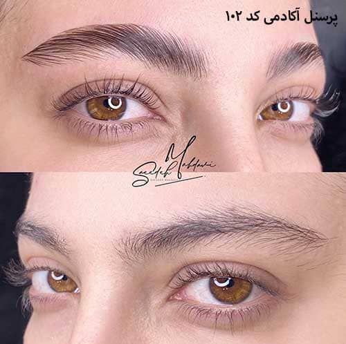 لیفت ابرو